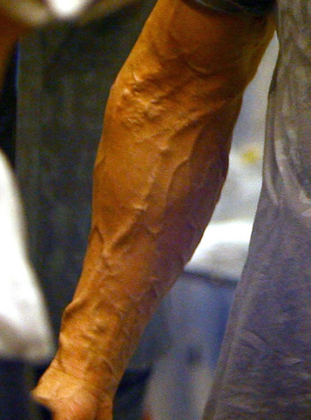 armveinolkdld1.jpg