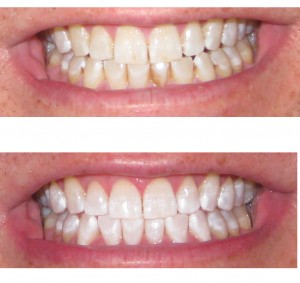 GeedingBeforeAfterTeethWhitening